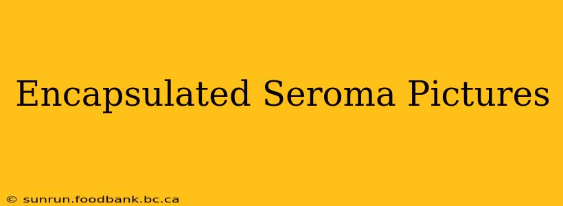 Encapsulated Seroma Pictures
