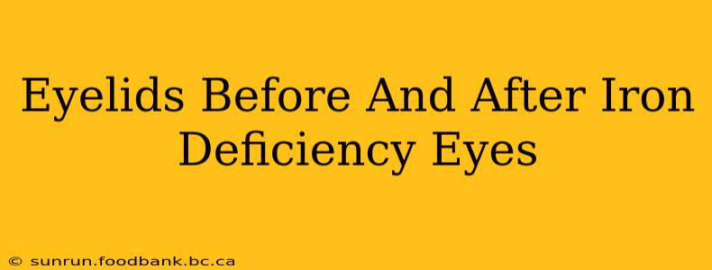 Eyelids Before And After Iron Deficiency Eyes