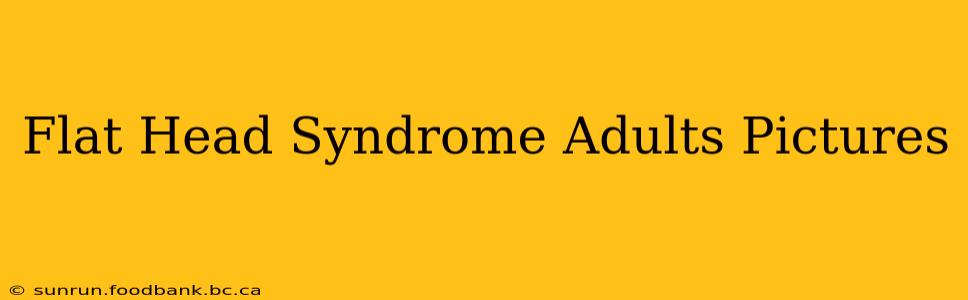 Flat Head Syndrome Adults Pictures