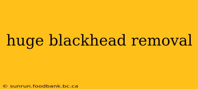 huge blackhead removal