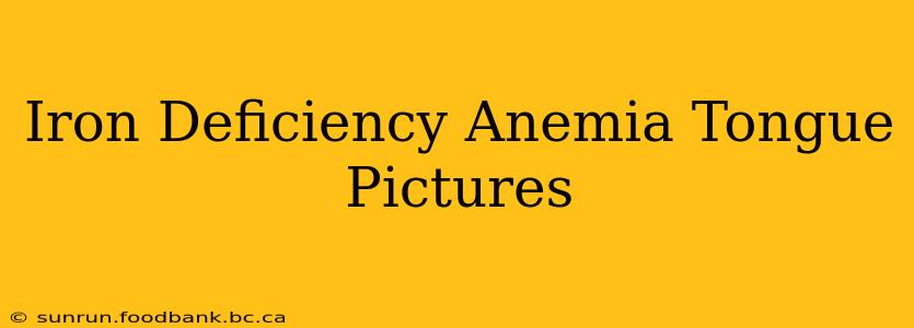 Iron Deficiency Anemia Tongue Pictures